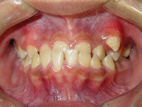 合肥牙齿不齐的危害有多少？